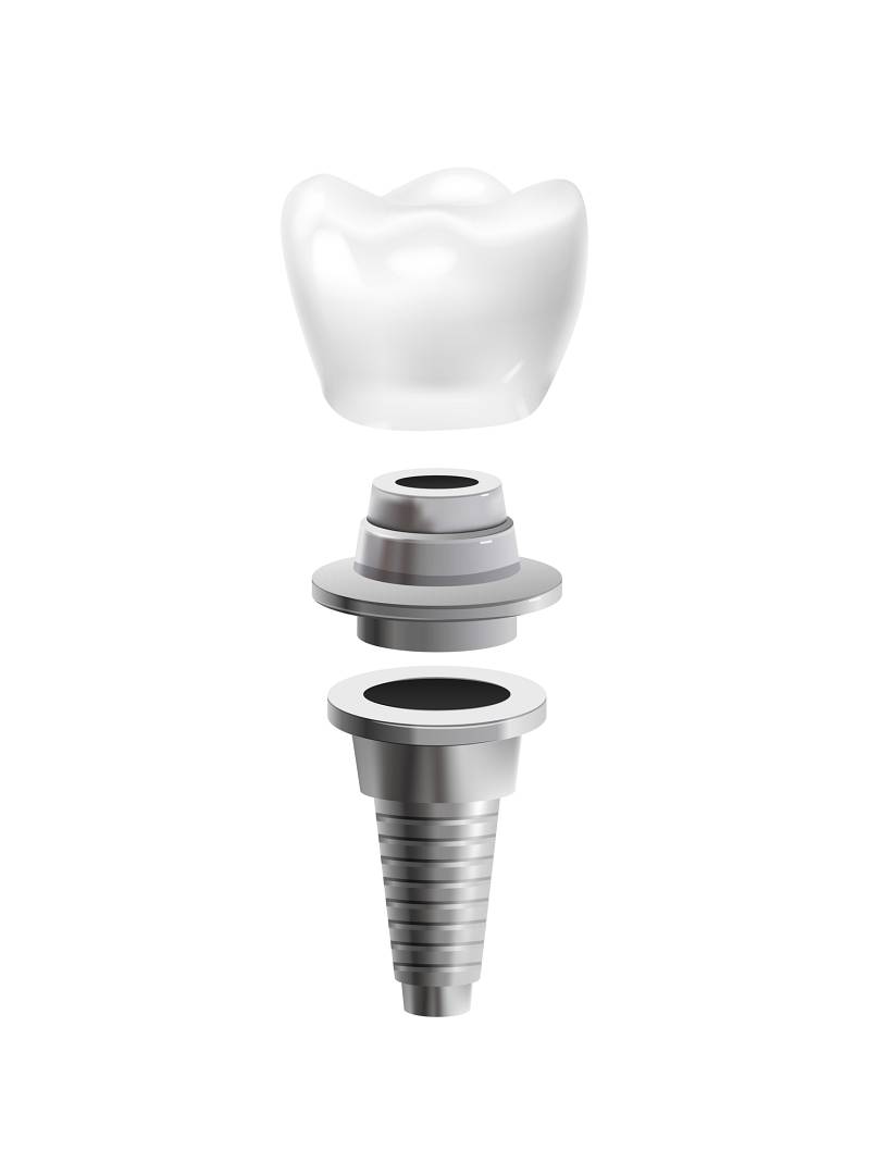 Recapătă-ți zâmbetul frumos cu un implant dentar!